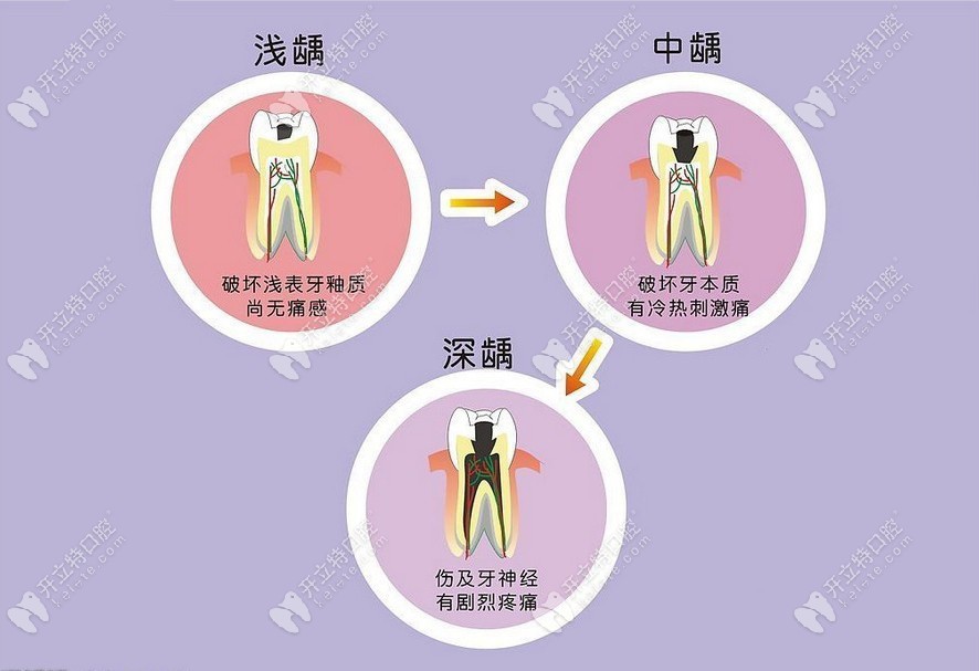 龋齿与蚂蚁庄园，守护口腔健康的小知识-第2张图片